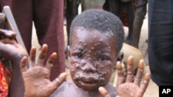 Pendant des siècles, la variole a été l'une des maladies les plus redoutées et mortelles au monde