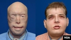 A firefighter gets new face in the most extensive face transplant in history. (VOA FILE PHOTO)