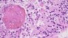 Jedan od nasmrtonosnijih tumora: glioblastom