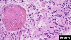 FILE - A high magnification image from a 2012 glioblastoma case is seen as an example in this College of American Pathologists image released from Northfield, Ill., July 20, 2017. 