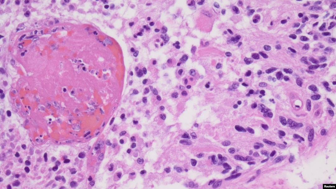 FILE - A high magnification image from a 2012 glioblastoma case is seen as an example in this College of American Pathologists image released from Northfield, Ill., July 20, 2017. 