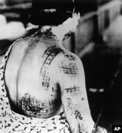 A Japanese victim of the nuclear attack on Hiroshima is treated at a U.S. army hospital in Hiroshima in Sept. 1945.