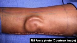 Cartilage in the shape of an ear growing in a patient's forearm is shown as part of cutting-edge total ear reconstruction. (Photo Credit: U.S. Army photo ) 