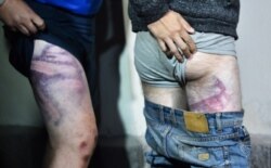 FILE - People detained during recent rallies of opposition supporters, who accuse Alexander Lukashenko of falsifying the polls in the presidential election, show their marks from beatings as they leave the Okrestina prison, in Minsk, Aug. 14, 2020.
