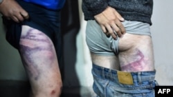 Сторонники оппозиции демонстрируют травмы, полученные во время заключения в СИЗО "Окрестина", август 2020 г. (архивное фото Sergei GAPON / AFP)