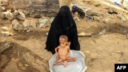 FILE - Moaz Ali Mohammed, a two-year-old Yemeni boy from an impoverished family in the Bani Amer region, who suffers from acute malnutrition, is bathed by his mother outside their house in the Aslam district in the northern Hajjah province, July 28, 2019.