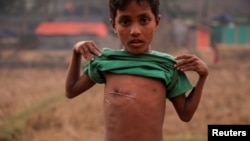 7岁的罗兴亚难民-莫哈马斯·索赫尔在孟加拉的难民营展示他身上枪伤留下的伤疤 （2017年12月19号）