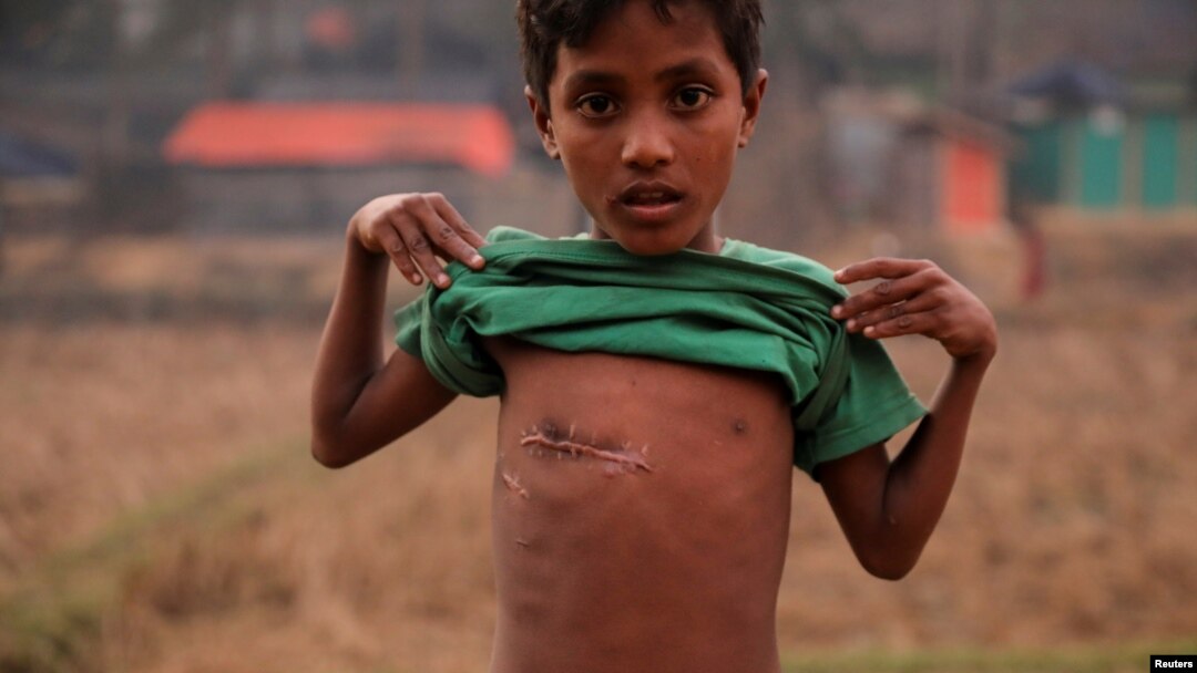 FILE - A 7-year-old Rohingya refugee, Mohammas Sohel, shows a bullet wound on his chest at the Kutupalong refugee camp near Cox's Bazar, Bangladesh, Dec. 19, 2017. 