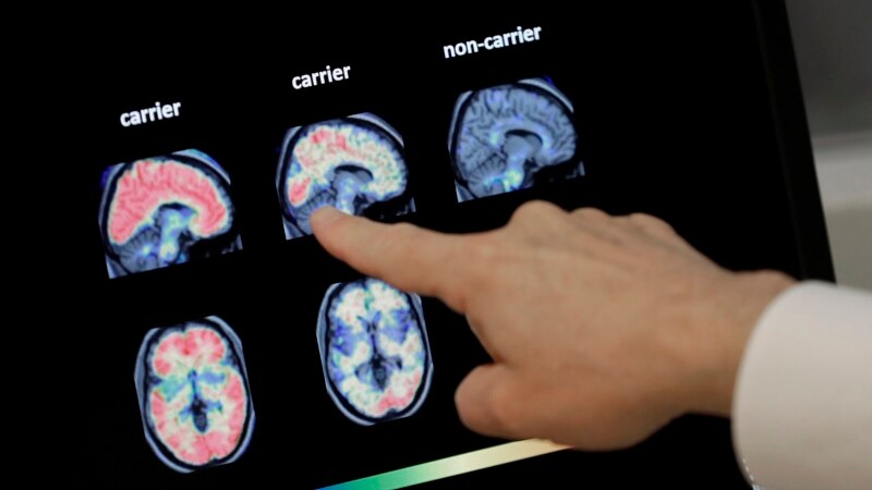 It Seems Like Alzheimer's but Peek Into Brain Reveals a Mimic