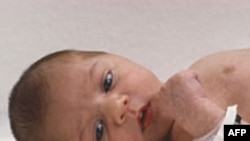 Amerika'da Sezaryen Doğum Oranı Artıyor