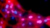 Ćelije raka dojke pod mikroskopom