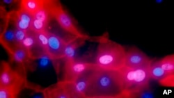 Ćelije raka dojke pod mikroskopom