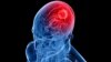 Patient’s Fat May Help Treat Brain Tumors