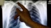Drug-Resistant Tuberculosis Less Likely to Spread