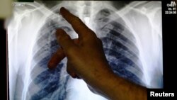 File - A doctor points to an x-ray showing a pair of lungs infected with tuberculosis in Ladbroke Grove in London, England.