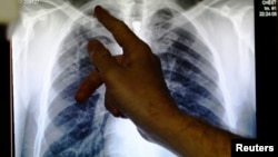 A doctor points to an x-ray showing a pair of lungs infected with TB (tuberculosis).