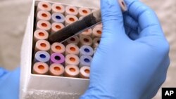 FILE - Lab research analyst does research relating to a new blood test. Researchers have developed a blood test that predicts Alzheimer's disease.