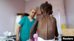 FILE - A nurse looks as he weighs a malnourished girl at a malnutrition treatment center in Sanaa, Yemen, Oct. 7, 2018.