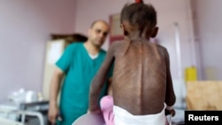 FILE - A nurse looks as he weighs a malnourished girl at a malnutrition treatment center in Sanaa, Yemen.