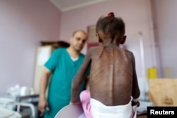 FILE - A nurse looks as he weighs a malnourished girl at a malnutrition treatment center in Sanaa, Yemen.