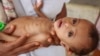 UNICEF: Krisis Malnutrisi di Yaman Memburuk