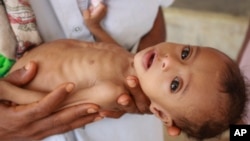 Bayi berusia 7 bulan, Issa Ibrahim Nasser, dirawat di rumah sakit akibat kekurangan gizi (malnutrisi) akut di Deir Al-Hassi, Yaman. 
