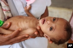 Issa Ibrahim Nasser yang berusia tujuh bulan dibawa ke sebuah klinik di Deir Al-Hassi. Pada usia tujuh bulan, berat Issa hanya tiga kilogram. (Foto: AP)