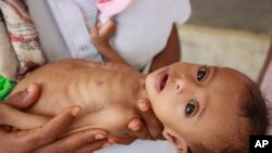 Issa Ibrahim Nasser (tujuh bulan) dibawa ke sebuah klinik di Deir Al-Hassi, dalam foto bertanggal 14 Juni 2020 ini. Pada usia tujuh bulan, berat Issa hanya tiga kilogram. (AP Photo/Issa Al-Rajhi)
