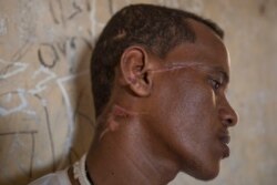 Abrahaley Minasbo a 22-year-old trained dancer and Tigrayan survivor from Mai-Kadra, Ethiopia, shows wounds on his face inside a shelter, in the Hamdeyat Transition Center near the Sudan-Ethiopia border, eastern Sudan, Tuesday, Dec. 15, 2020.