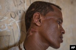 Abrahaley Minasbo a 22-year-old trained dancer and Tigrayan survivor from Mai-Kadra, Ethiopia, shows wounds on his face inside a shelter, in the Hamdeyat Transition Center near the Sudan-Ethiopia border, eastern Sudan, Tuesday, Dec. 15, 2020.