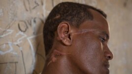 Abrahaley Minasbo a 22-year-old trained dancer and Tigrayan survivor from Mai-Kadra, Ethiopia, shows wounds on his face inside a shelter, in the Hamdeyat Transition Center near the Sudan-Ethiopia border, eastern Sudan, Tuesday, Dec. 15, 2020.
