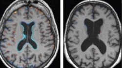 MRI scans showing brains of two patients in the Oxford study. The patient on the left did not have active vitamin treatment, while the person on the right did.