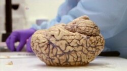 Scientists Research the Brain in an Effort to Stop Parkinson’s Disease