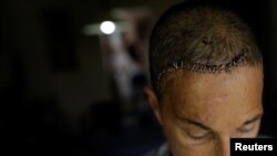 Yolyter Rodriguez, 56, a housewife and a mother of three who was injured during a protest against Venezuela's President Nicolas Maduro's government, poses for a photograph at her home in Caracas, Venezuela, Aug. 11, 2017. 