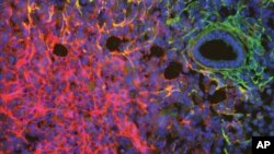 تصویر سلول‌های سرطان پستان در مجاورت رگ‌های خونی - آرشیو