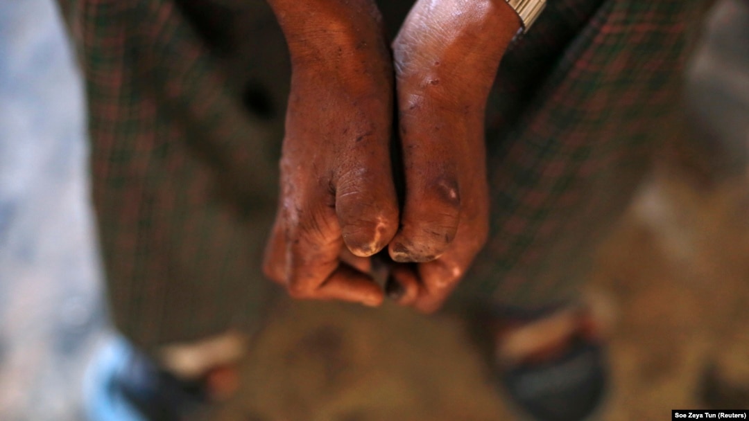 Penyakit kusta dulu dianggap kutukan. Upaya edukasi dan pengobatan terus dilakukan, tapi hingga saat ini masih banyak tantangan harus diselesaikan. (Foto: Reuters/Soe Zeya Tun)
