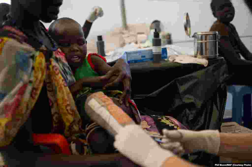 A boy who suffered severe burns to his leg is tended to by a Médecins Sans Frontières (MSF) doctor at the MSF clinic set up at the camp for displaced people in the grounds of the United Nations Mission to South Sudan (UNMISS) base in Juba.