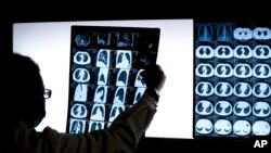 In this Thursday, Dec. 8, 2016 photo, Chinese doctor Peng Limei looks at a CT scan of a lung cancer patient at the Jingdong Zhongmei private hospital in Yanjiao, China's Hebei Province. (AP Photo/Andy Wong)