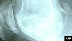 Ushtrimet fizike lehtësojnë dhimbjet nga pezmatimi i kyçeve