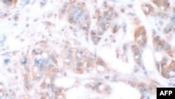 Tkivo dojke zaraženo kancerom