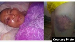 Các bức ảnh chụp hai nạn nhân bị đánh nặng nhất cho thấy vùng mắt sưng húp cũng như tay, chân bị thâm tím. Ông Đậu Hoàng Anh (trái) và chân của ông Đào Ngọc Cường bị đánh bầm dập. (ảnh chụp từ trang web VnExpress).