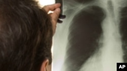 Mais De Um Terço Da População Mundial Infectada Com Tuberculose