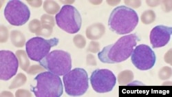 Imagen microscópica de células con leucemia aguda linfoblástica (VashiDonsk/Wikimedia Commons).