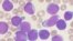 Imagen microscópica de células con leucemia aguda linfoblástica (VashiDonsk/Wikimedia Commons).
