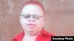 Siphelile Machingamire Woman Living With Albinism