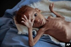 FILE- a severely malnourished boy rests on a hospital bed at the Aslam Health Center, Hajjah, Yemen.