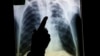 Prueba sencilla detecta cáncer de pulmón