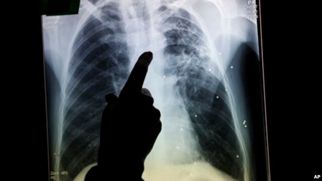 Los tumores pulmonares son detectados con frecuencia por medio de Rayos X o tomografías computarizadas.