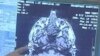 New Imaging Technique Reveals Mild Brain Injuries in Soldiers