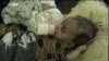 کودک مبتلا به سو تغذی در شفاخانه میرویس قندهار